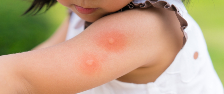 Mosquito bites on a child in Telford, PA.